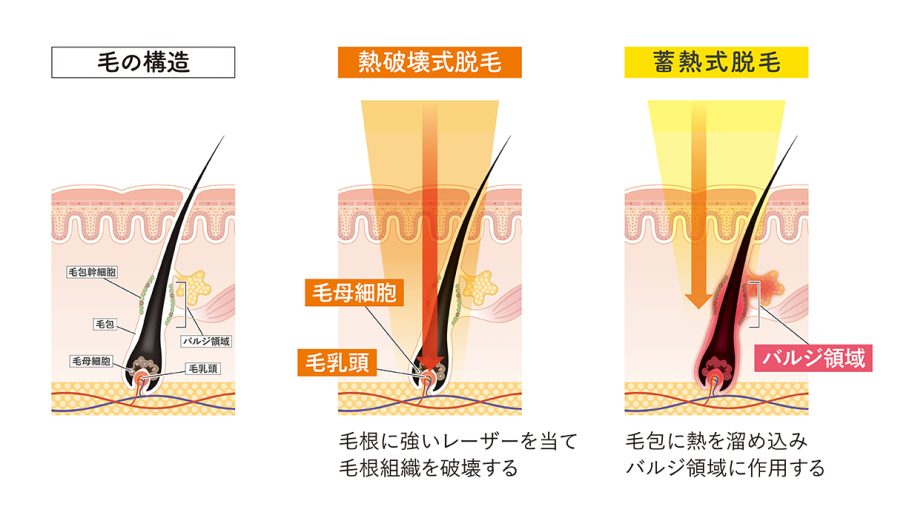 3. 脱毛の作用機序